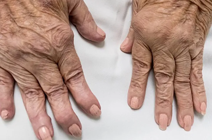 چگونه از روماتیسم مفصلی پیش‌گیری کنیم؟